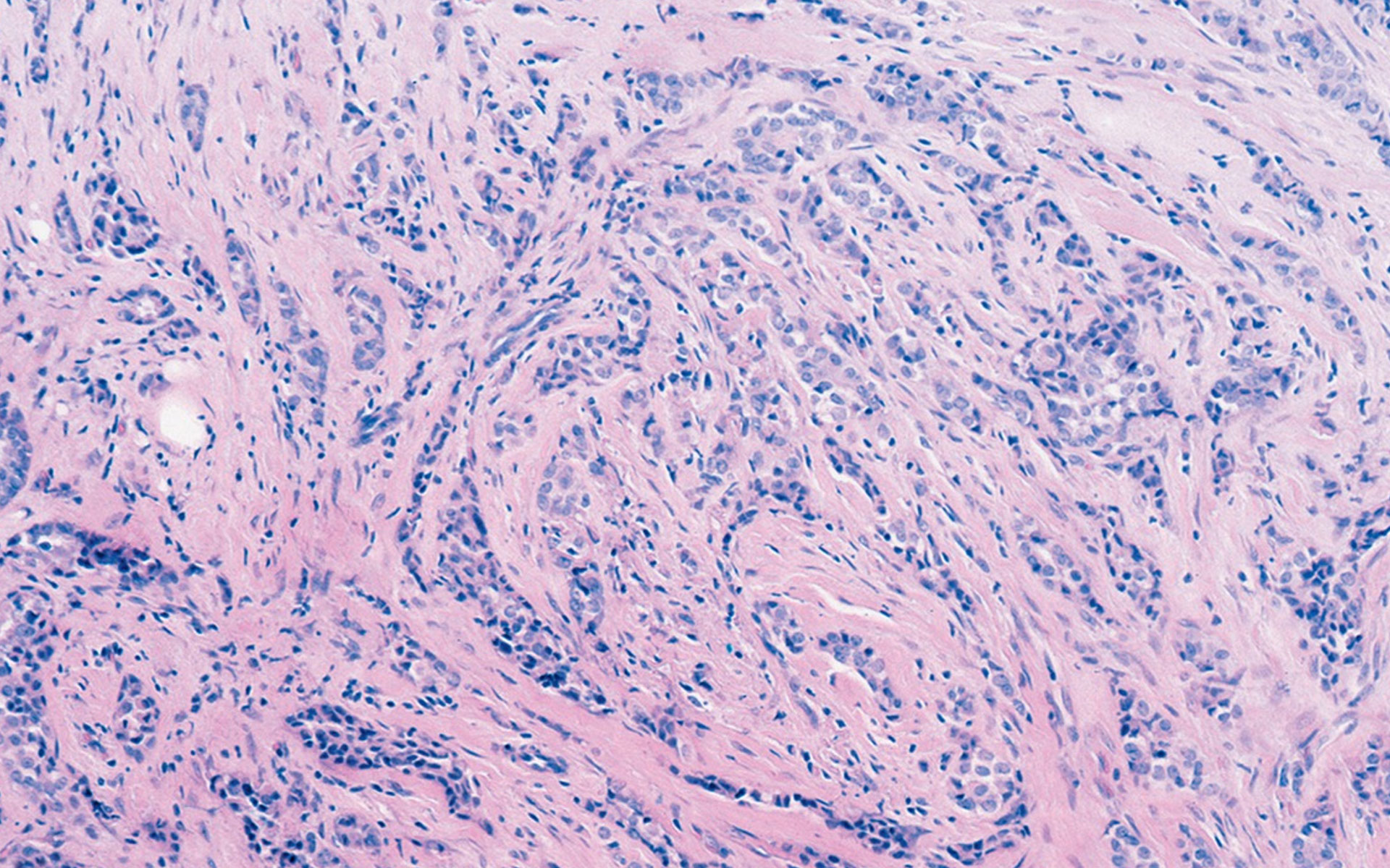 breast-cancer-ductal-carcinoma