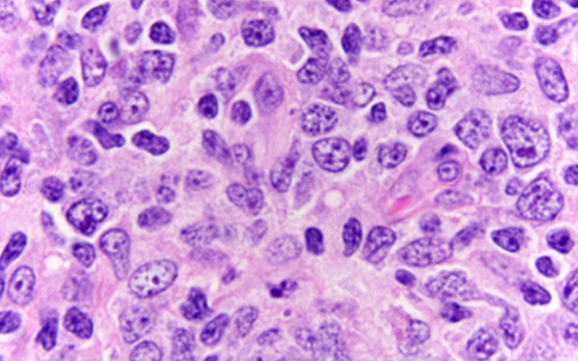 Lymphoma