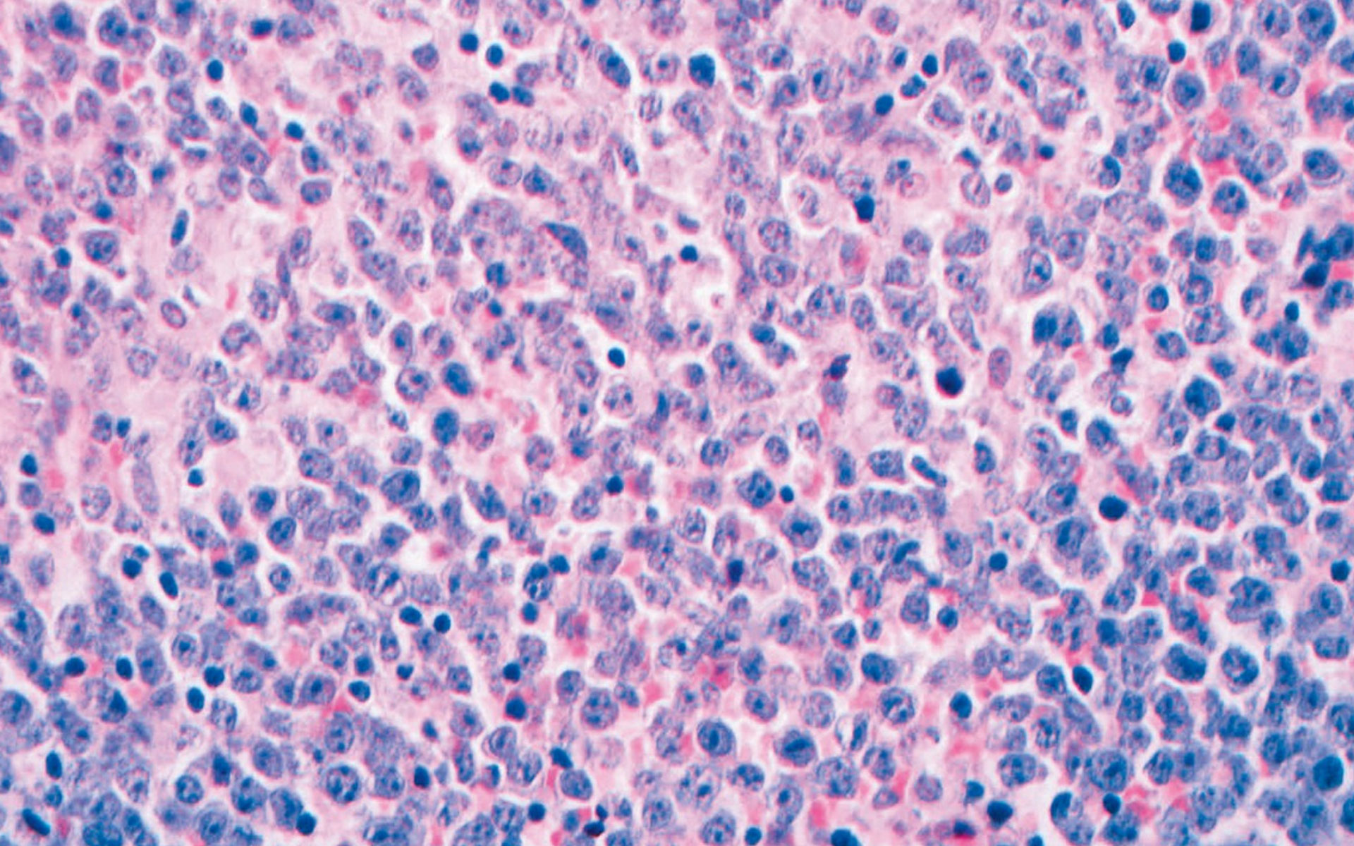 non-hodgkin-lymphoma