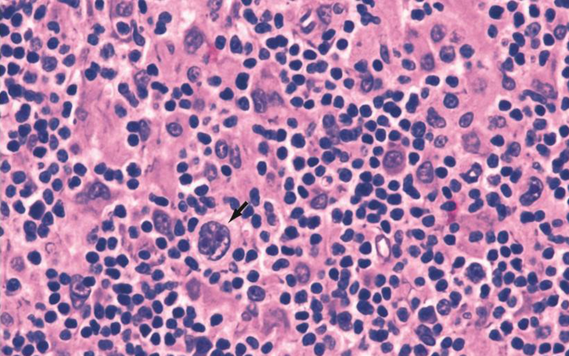 hodgkins_lymphoma