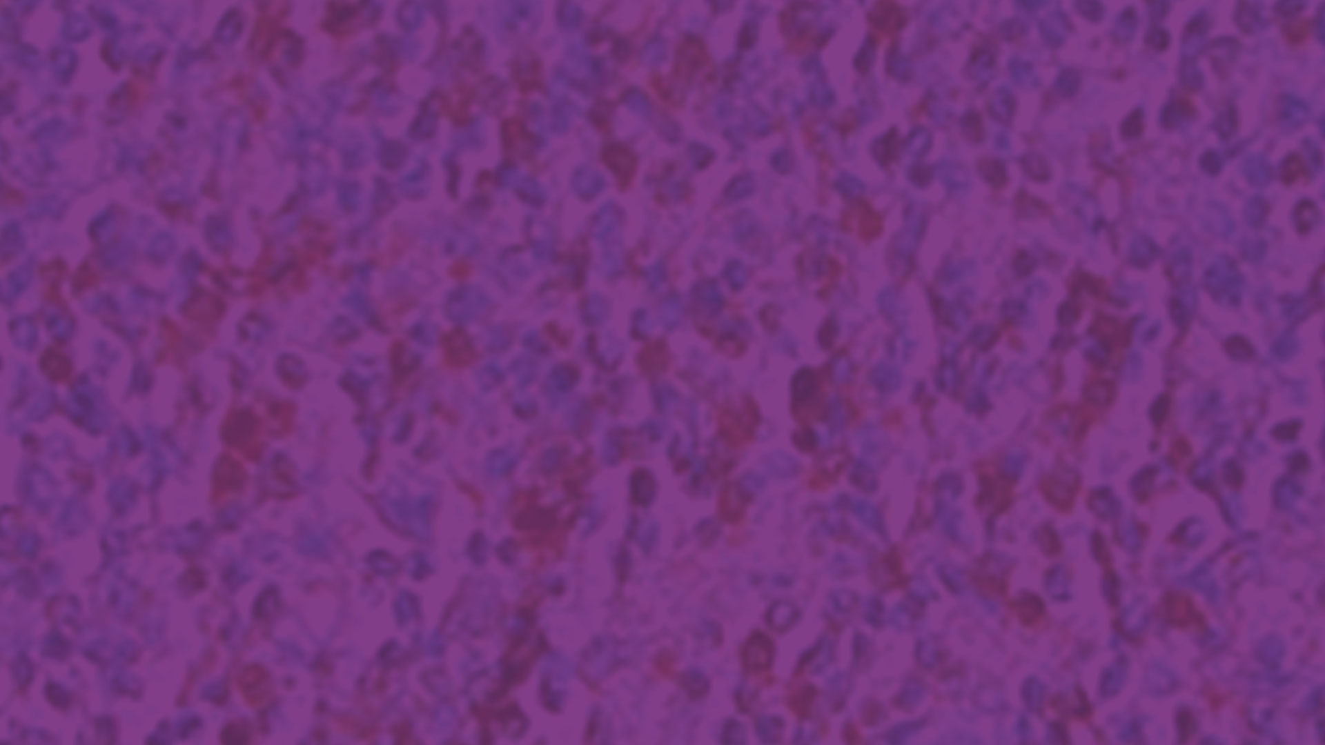 Slider-Image-lymphoma