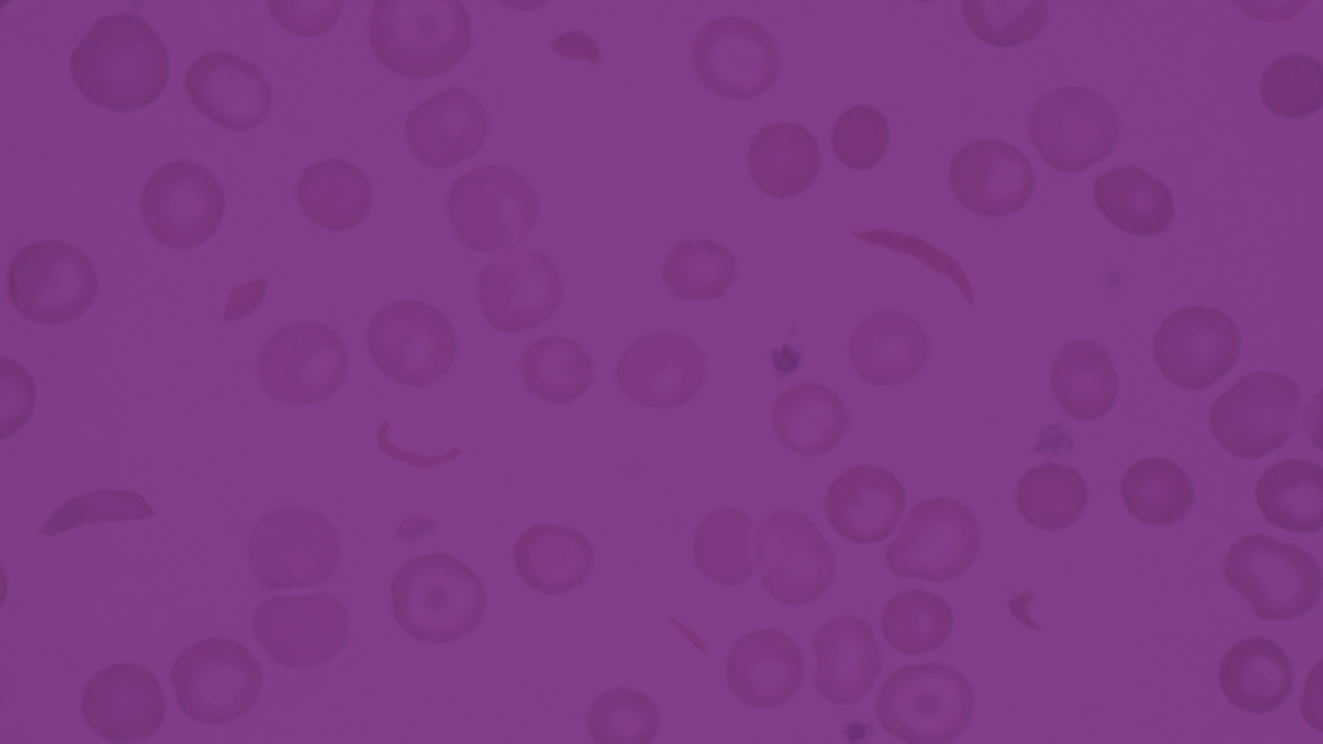 Slider-Image-sickle-cell-disease