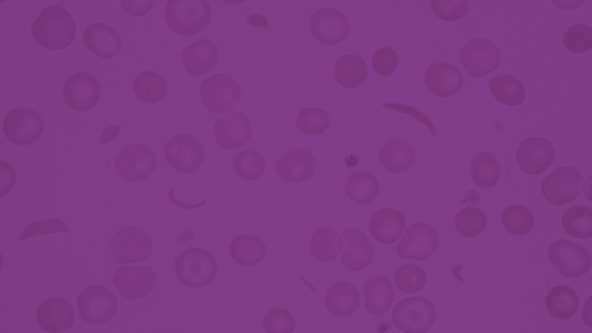 Slider-Image-sickle-cell-disease