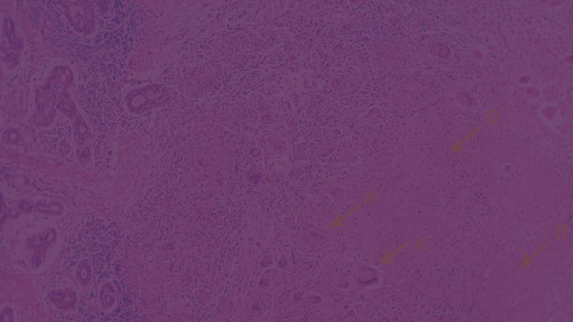 Slider-Image-Tuberculosis