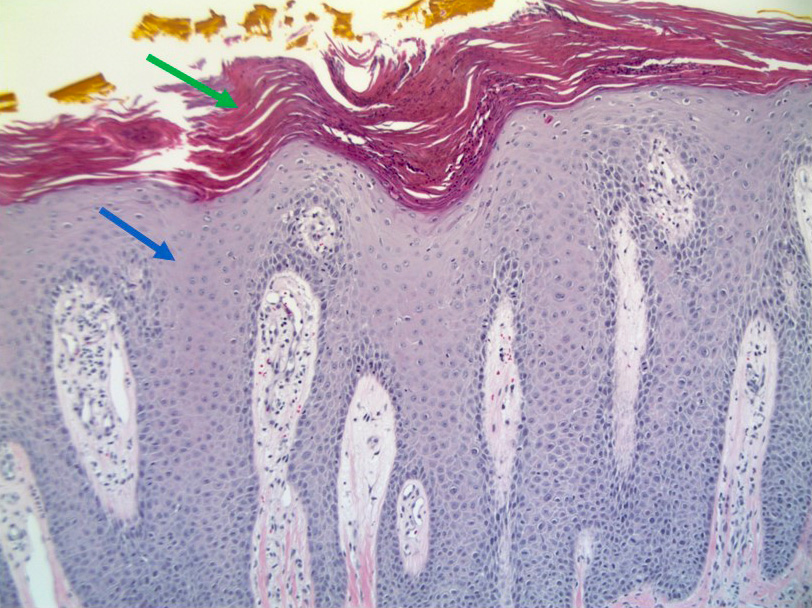 Psoriasis