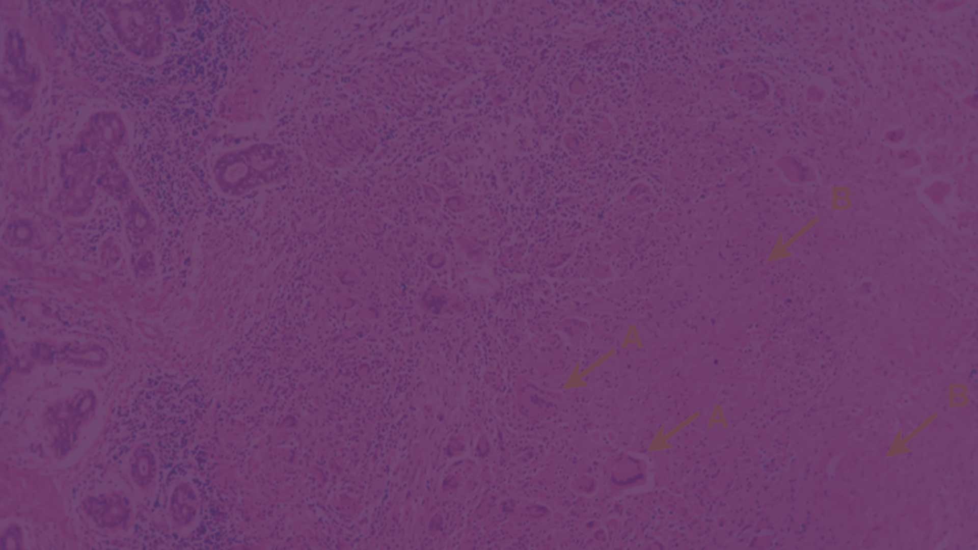 Slider-Image-Tuberculosis