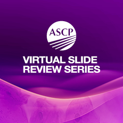 ASCP Virtual Slide Review Series Challenging Differential Diagnoses in Lung Biopsies Live Webinar